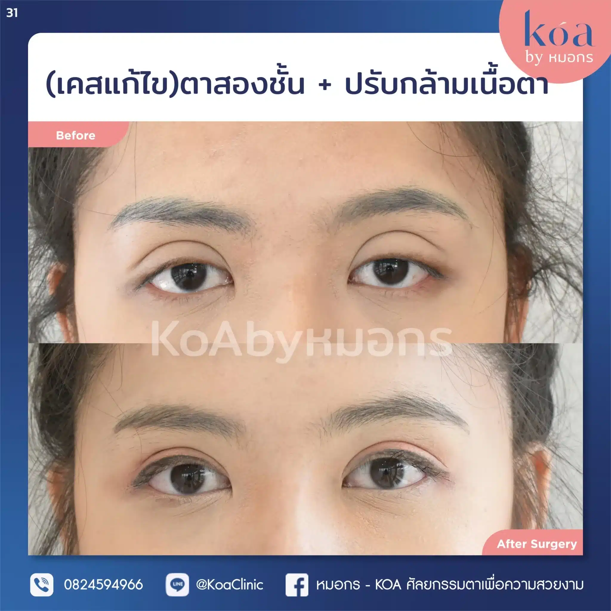 เคสแก้ตาสองชั้นที่ KOA Clinic)