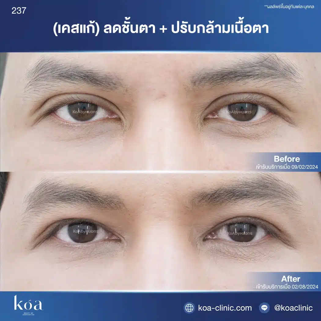 เคสแก้ตาสองชั้นที่ KOA Clinic