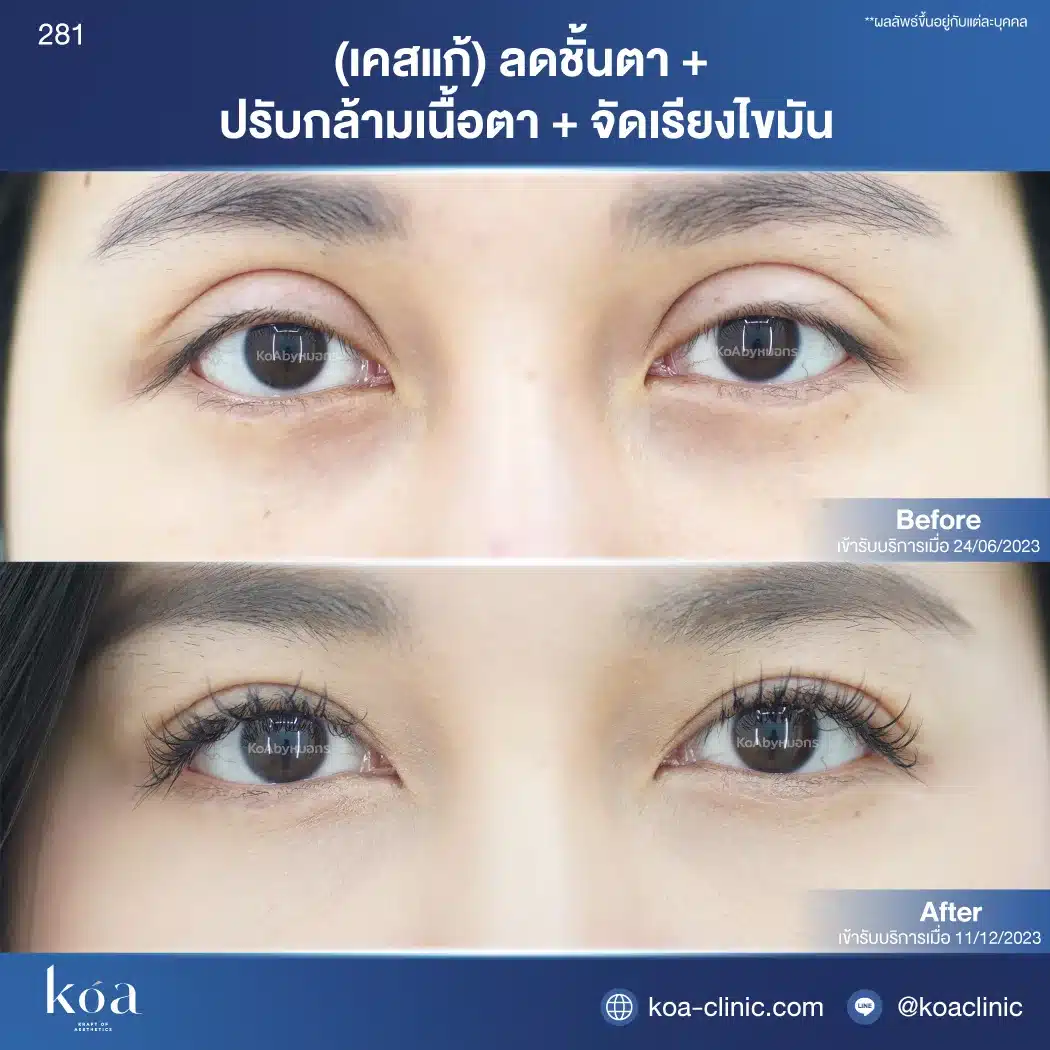 เคสแก้ตาสองชั้นที่ KOA Clinic