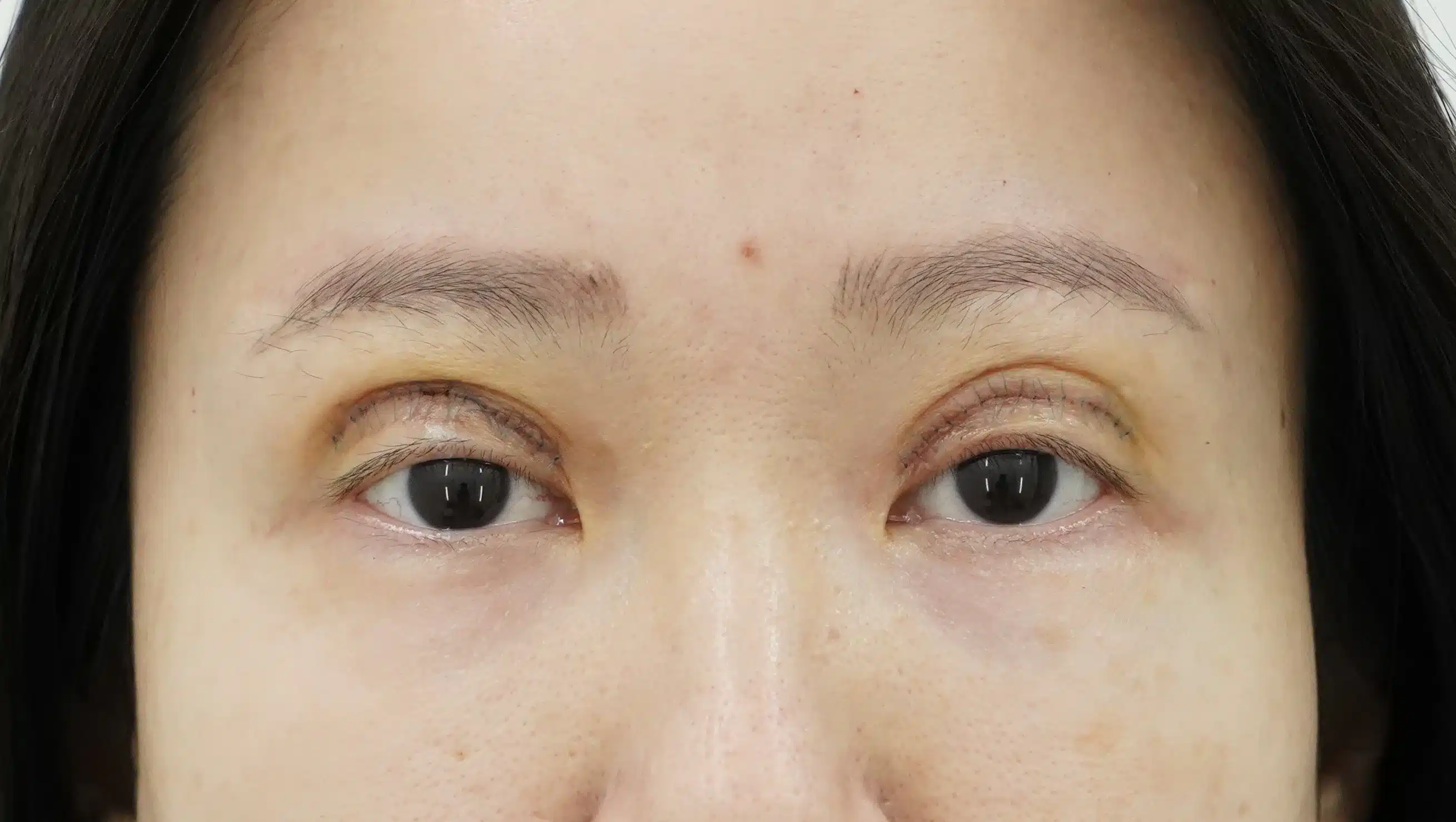 ชั้นตาซ้อน (ตาสามชั้น)