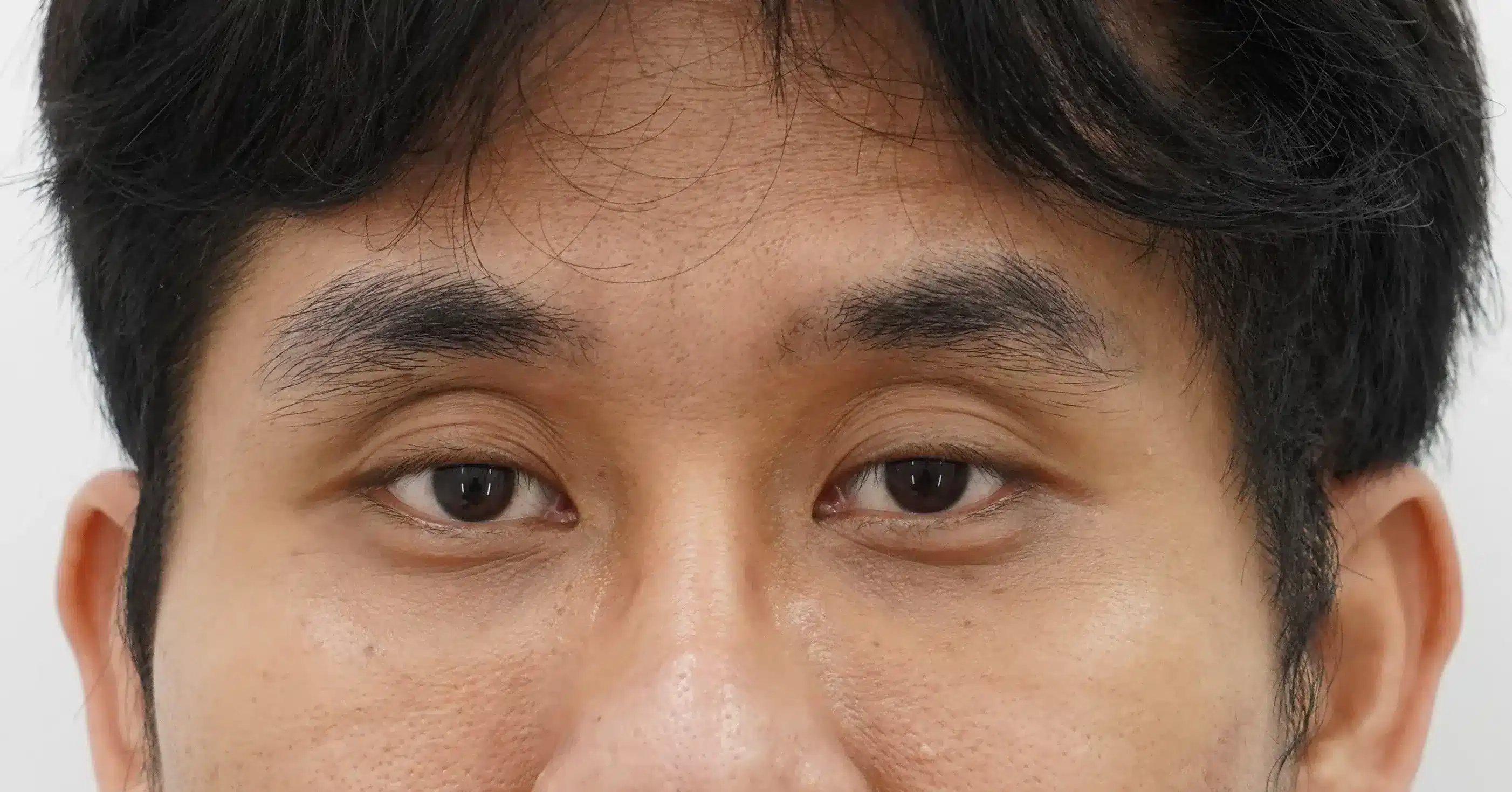 เบ้าตาลึก